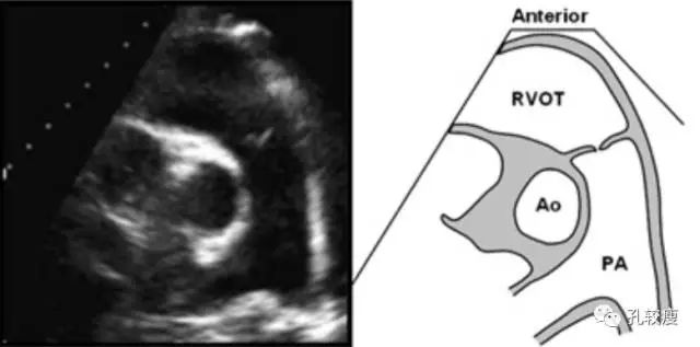 大动脉短轴切面:主要用于显示右心室前壁,三尖瓣前瓣,隔瓣▲右心室