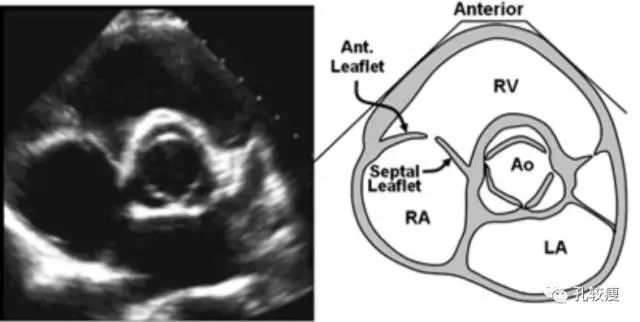 三尖瓣瓣叶超声解剖图片