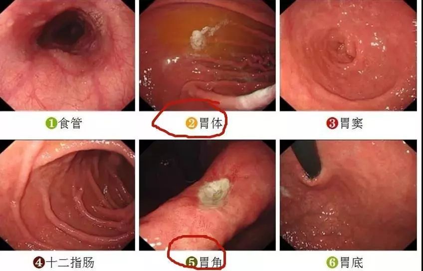 做完胃鏡胃到底有沒有問題教你快速看懂胃鏡報告