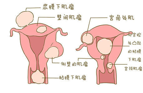 由于子宫肌瘤主要是由子宫平滑肌细胞增生而成,其中有少量纤维结缔