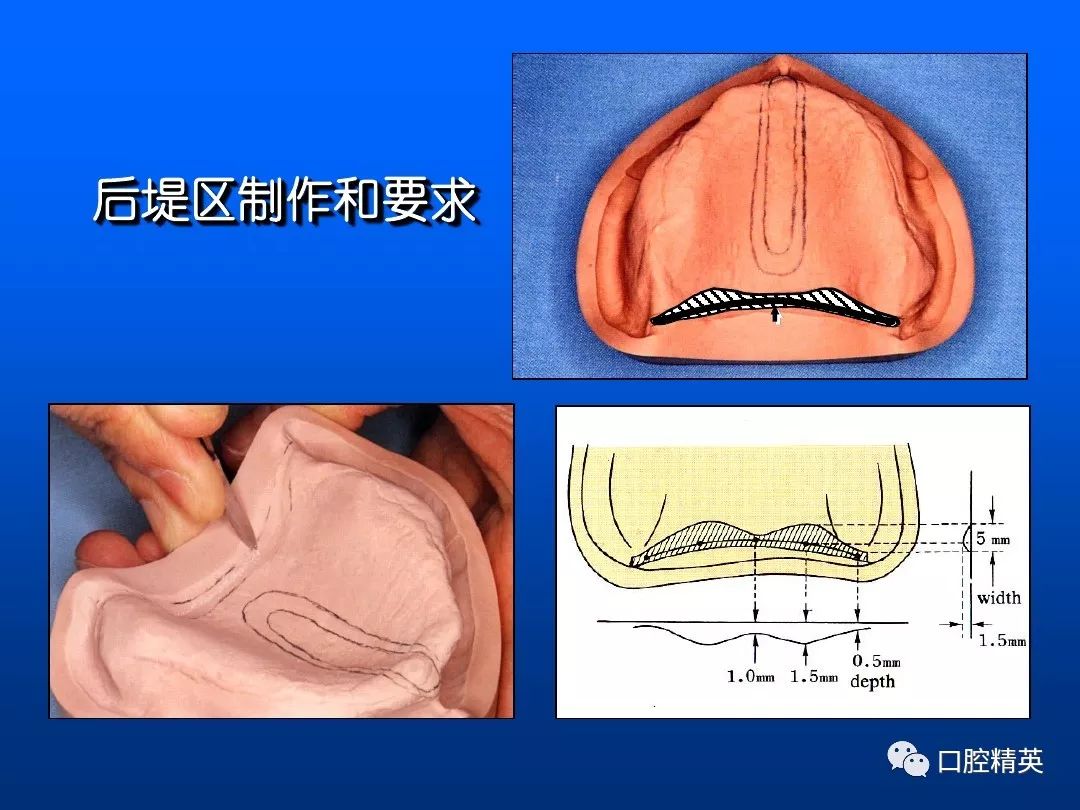 口腔印模 名词解释图片