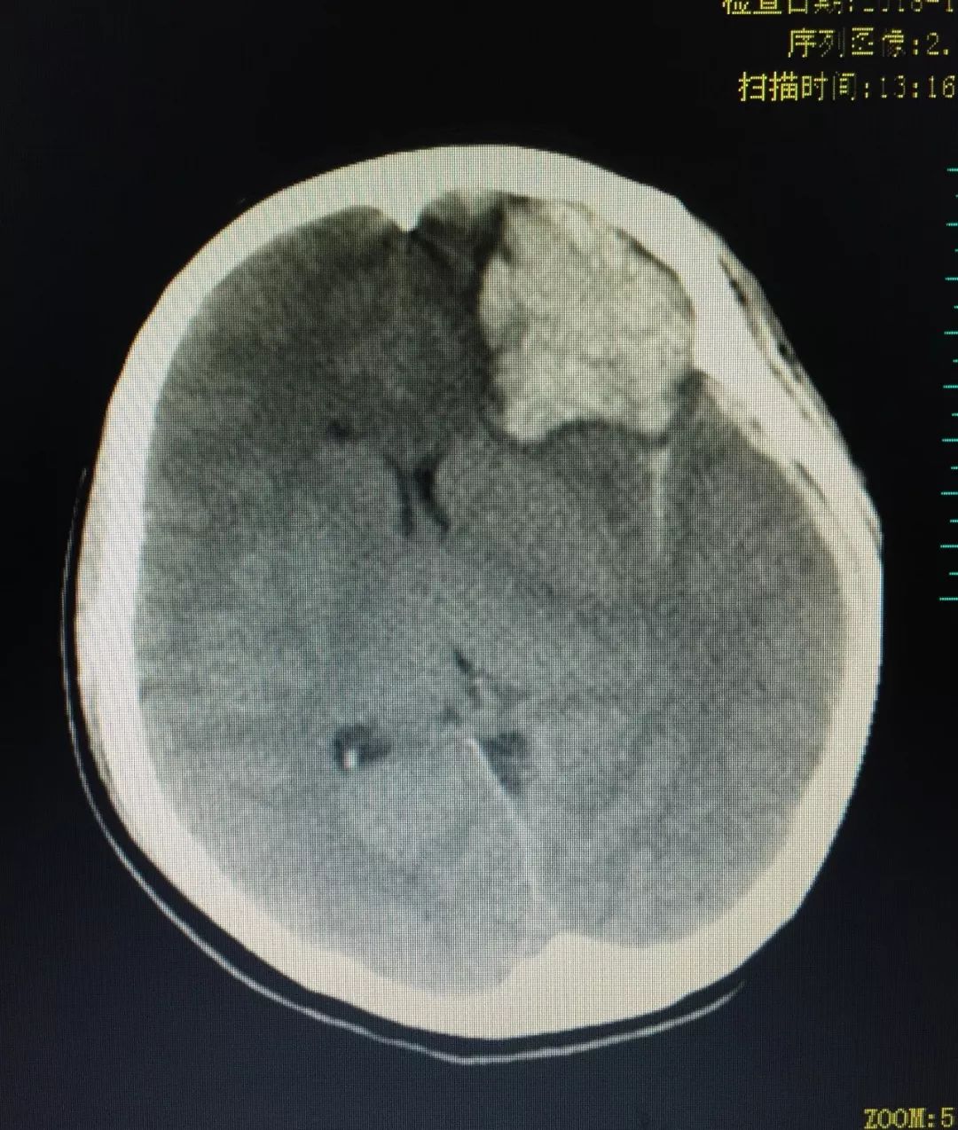 急診頭顱ct:左側額葉出血,左側急性硬腦膜下血腫,左側外側裂池積血.