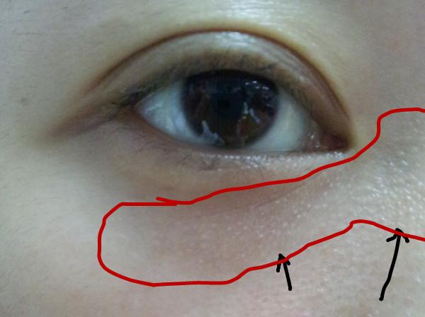 美容护肤技巧9:眼部脂肪粒怎么去除?去脂肪粒最有效的方法
