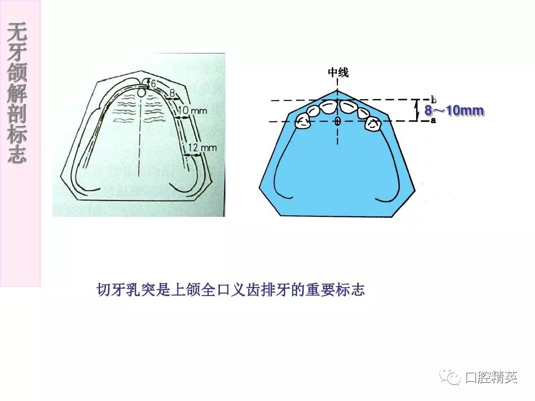 无牙颌解剖标志