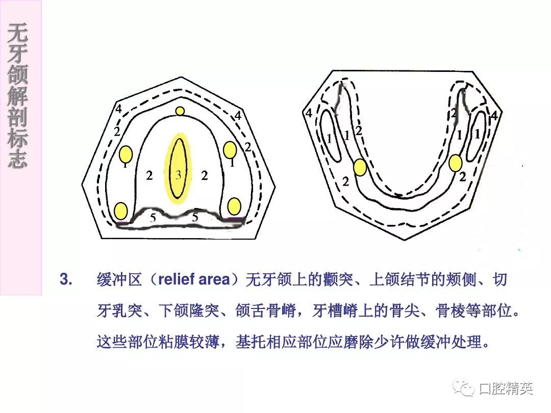 无牙颌的分区图片