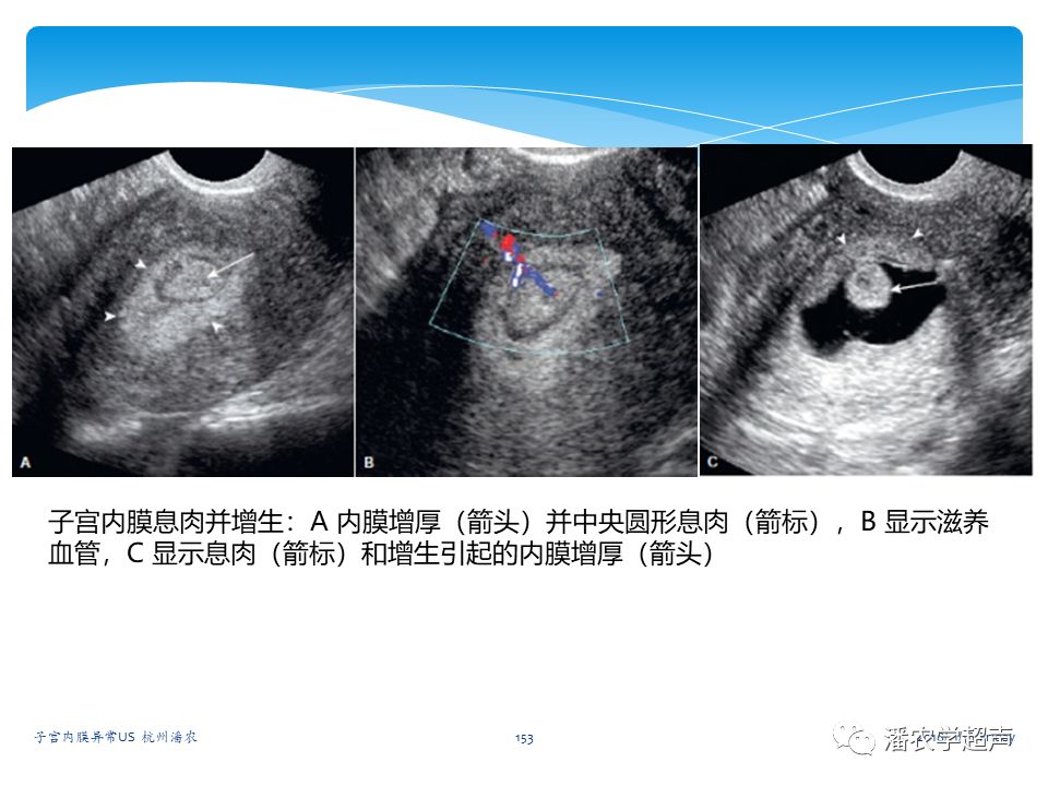 超聲微課堂子宮內膜異常的超聲診斷子宮內膜息肉的超聲診斷