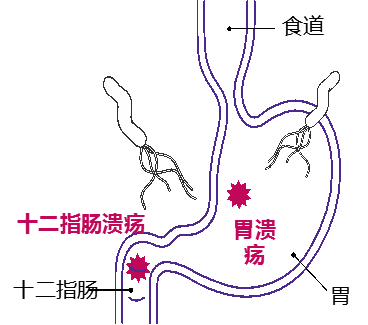 幽门螺杆菌结构模式图图片