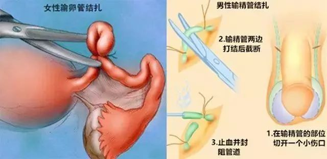 男性结扎位置图片