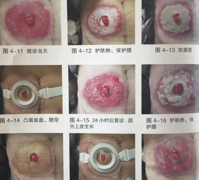 造口周围溃烂图片大全图片