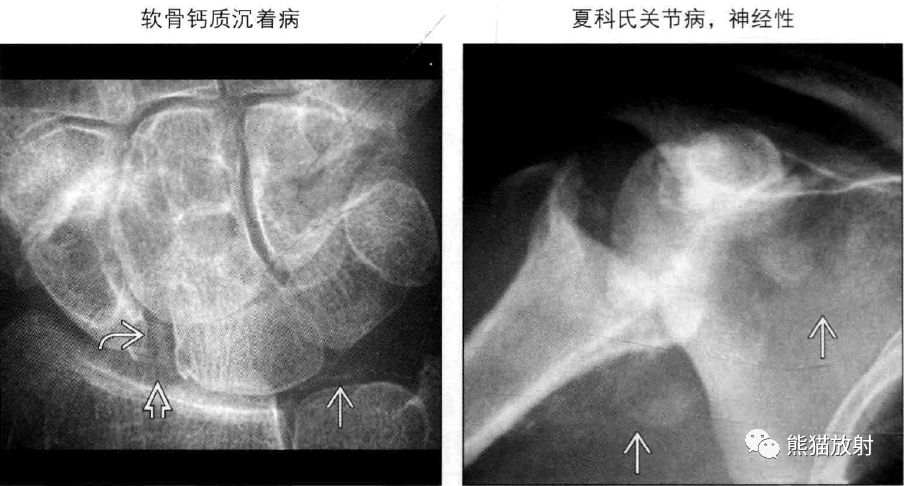 左图:肘关节内多个大的圆形游离体,脂肪垫膨胀,提示游离体位于关节内.