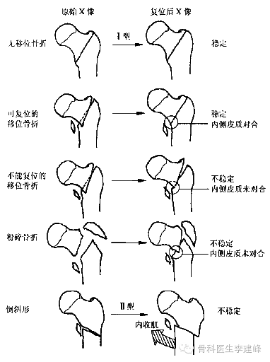 压疮股骨粗隆位置图图片