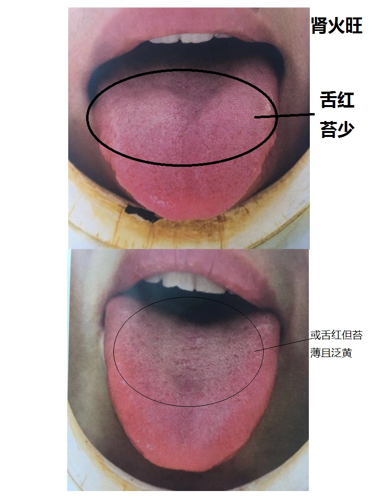 通过舌象简单有效辨别自己痘痘的反复炎症属体内什么热邪作怪