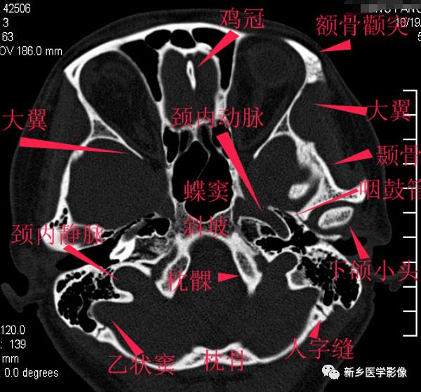 纯手工详细标注颅底解剖太赞了