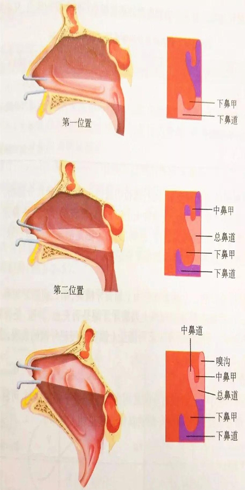 首大盛发军注意这些事会导致鼻甲肥大