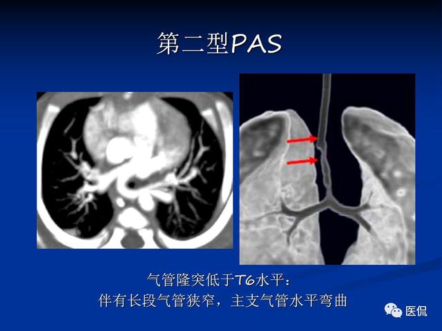 肺動脈吊帶的影像學表現 醫學影像經典ppt