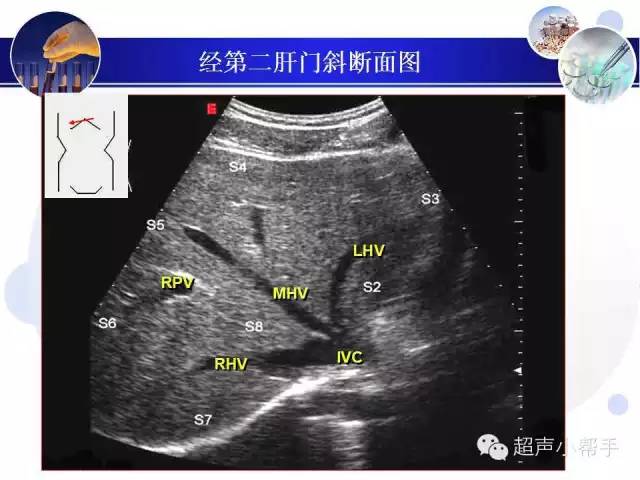 肝脏的8个分段超声图图片