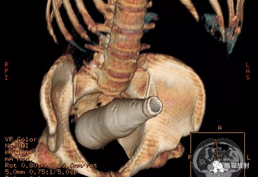 直肠异物丨影像表现震惊了