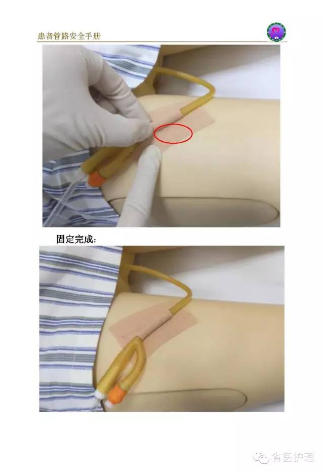 二腔导尿管图片
