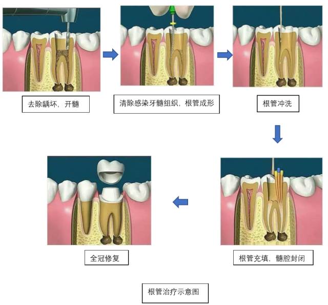 一組動圖讓你看懂根管治療