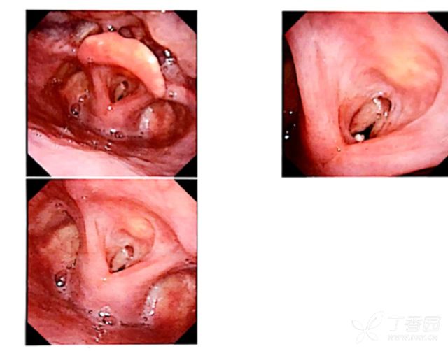 口服草甘膦 100 ml   个月后的喉镜检查:喉瘢痕狭窄,给予气管