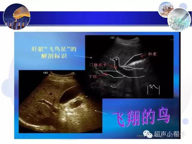 超声微课堂肝叶与肝段的超声图解