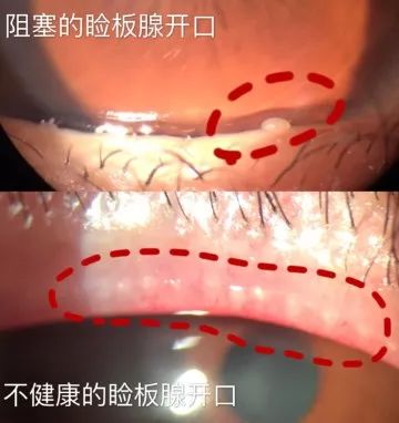 偷针眼图片眼睛图片