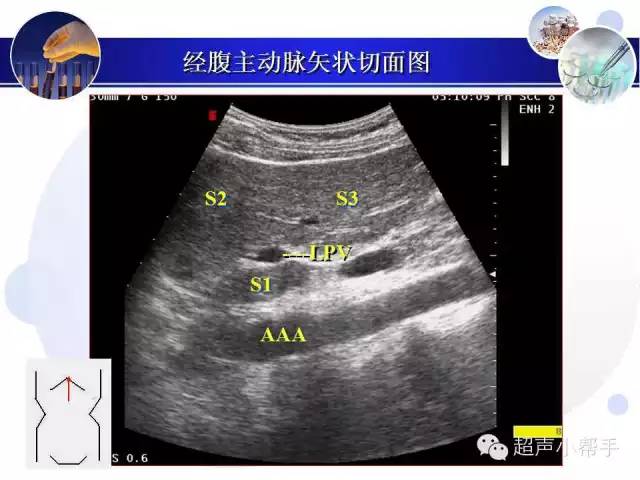 超声微课堂肝叶与肝段的超声图解