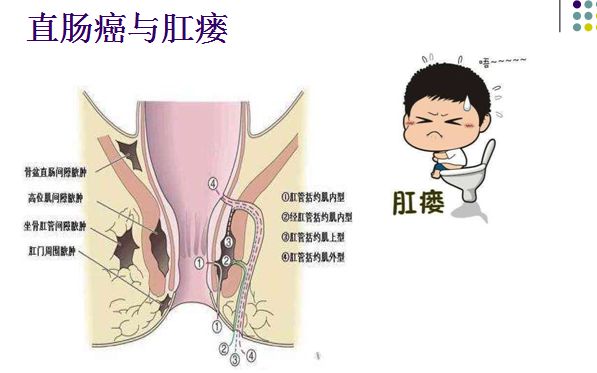 高位肛瘻的外口距肛門多在5cm以上,低位肛瘻距肛門較近,局部紅腫疼痛