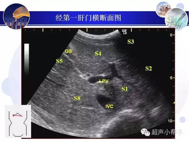 超声微课堂肝叶与肝段的超声图解