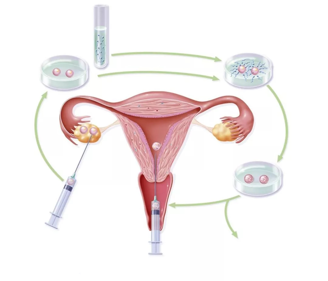 马来西亚什么是试管婴儿长方案(马来西亚试管移植)-第1张图片-鲸幼网