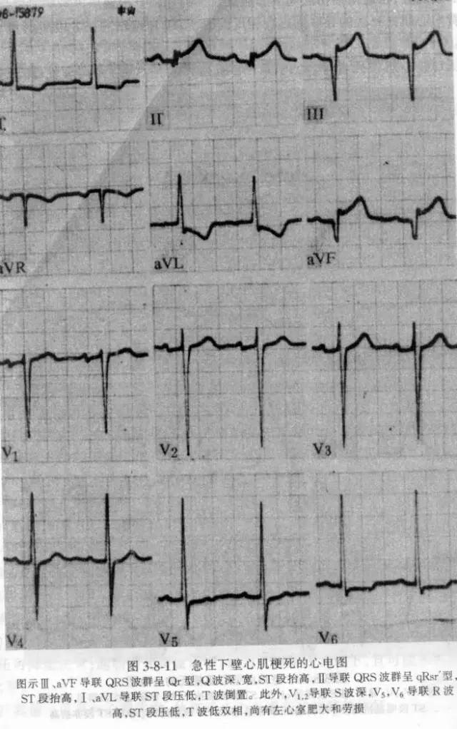 右室心肌梗死心电图图片