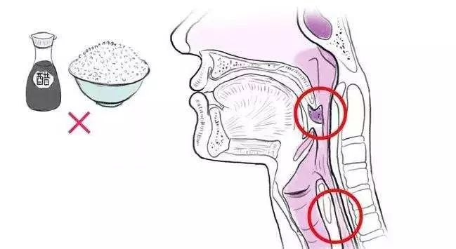 【健康知识】鱼刺卡喉咙,用吞饭喝醋的方法可能会威胁生命!