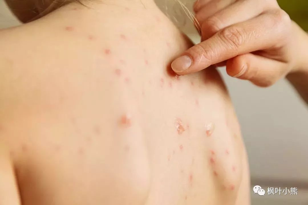 冬季儿童水痘高发传染期,预防治疗有妙方