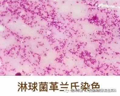淋病由淋病奈瑟菌(简称淋球菌)感染引起,主要表现为泌尿生殖系统的