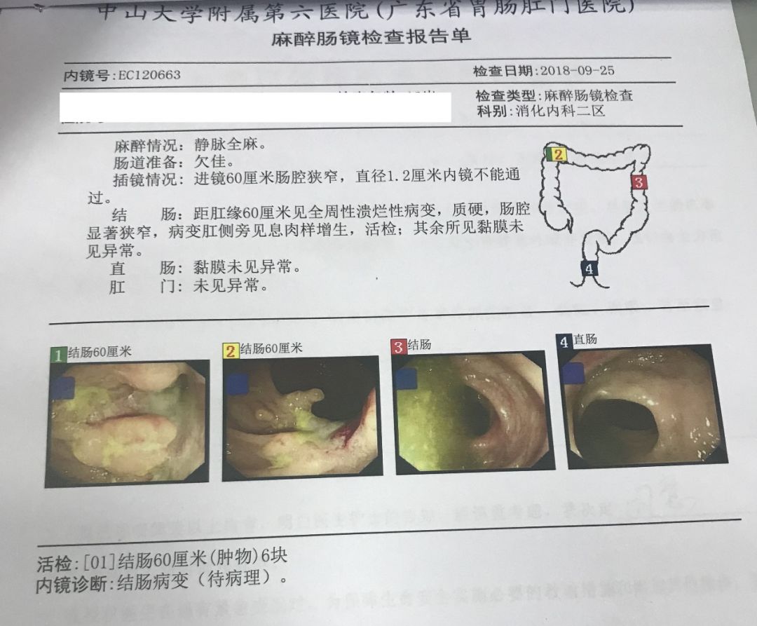 切除 迴腸造瘻術中可見:病變位於回盲部,於周圍組織粘連,組織充血水腫