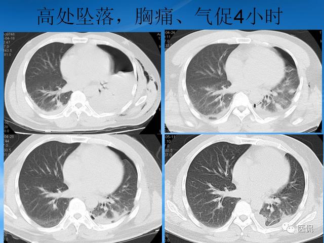 肺挫伤ct表现图片图片