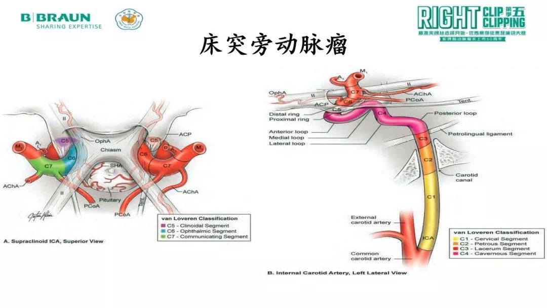 静脉大脑中动脉高流量搭桥辅助右侧颈内动脉床突段假性动脉瘤孤立术