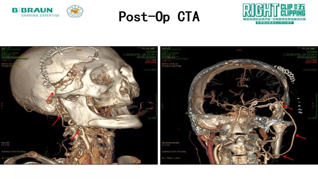 rcrc第五季精彩荟萃丨床突旁巨大动脉瘤手术治疗颈
