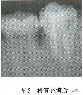 左下颌双生第二磨牙伴c型根管1例