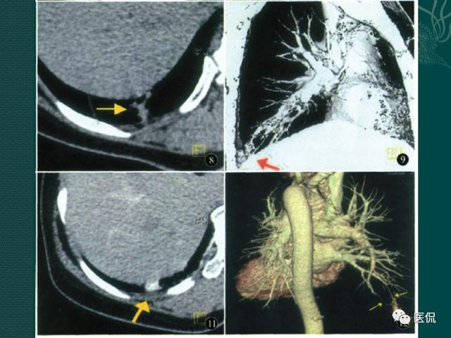 肺动静脉瘘的影像诊断 医学影像经典ppt
