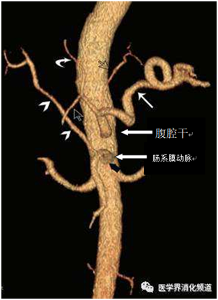 突破技术雷区-腹腔干破裂行生物胶栓塞