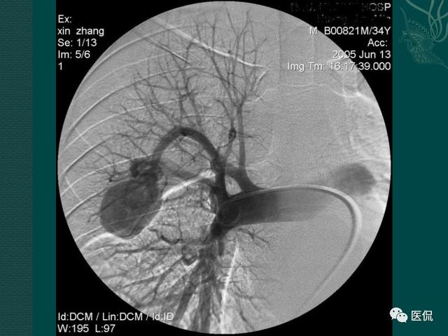 肺动静脉瘘的影像诊断 医学影像经典ppt