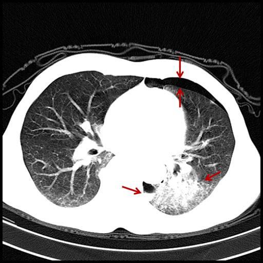 胸部ct显示左侧第7后肋骨折,伴左肺挫裂伤,左侧液气胸.