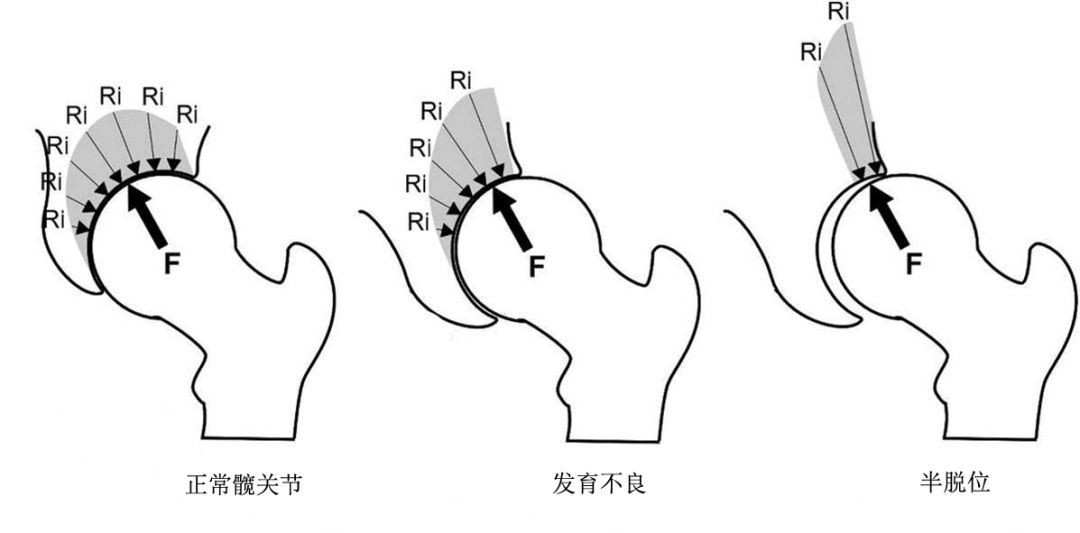 ddh 诊疗系列科普(2-为什么要治疗