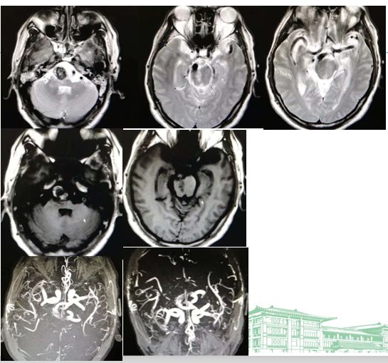 颅脑mri(08