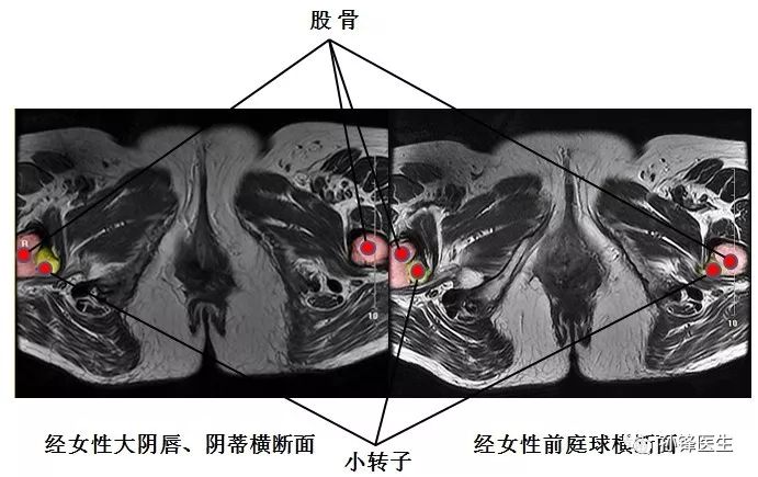 女性盆腔CT图解图片