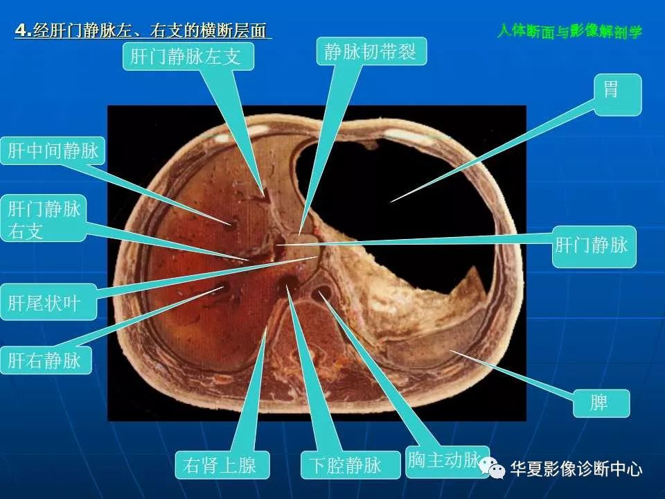 腹部断层影像解剖