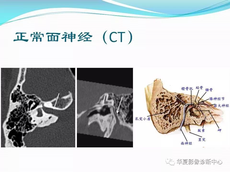 面神经横断面解剖图图片