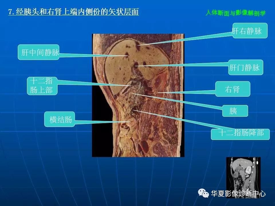 腹部斷層影像解剖續