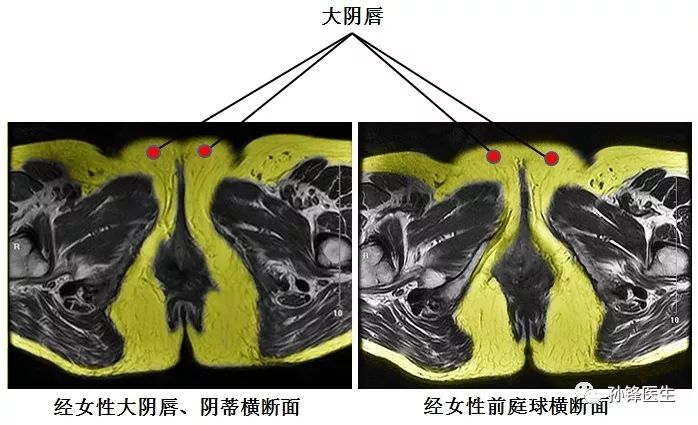 女性前庭球图片图片